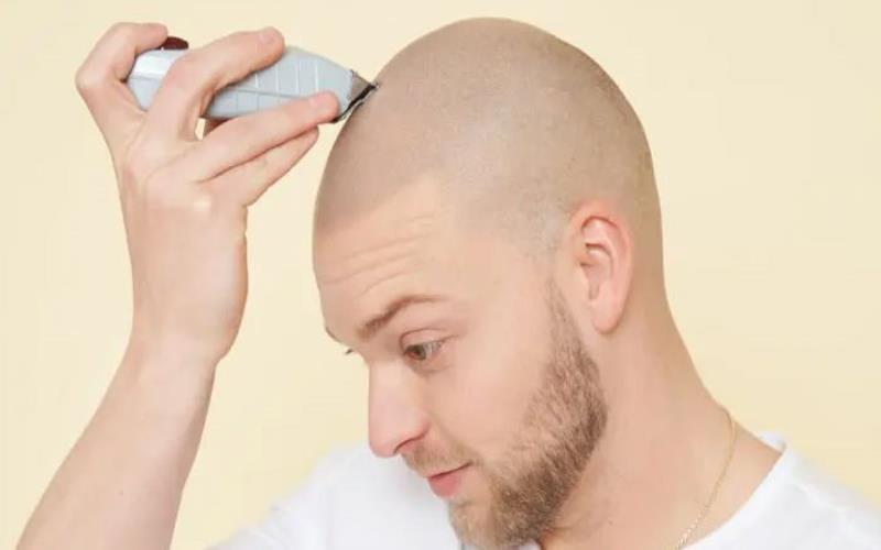 4 Types of Scalp Micropigmentation Treatments